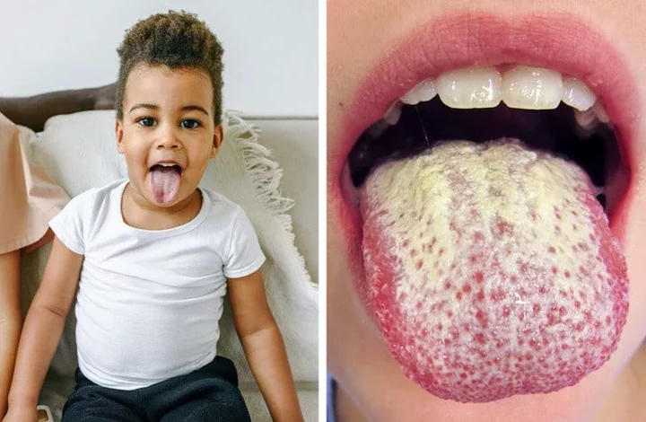 White Tongue: Symptoms, Causes, and Home Remedies for Treatment